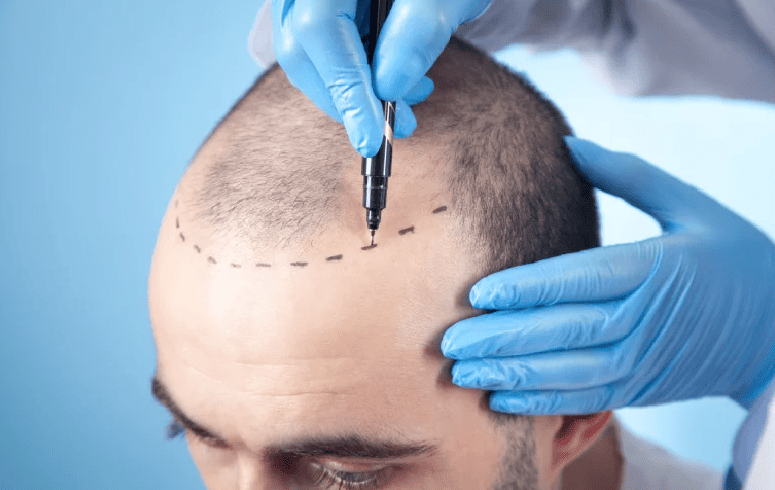Decided To Go For Hair Transplant – What Are The Next Steps?