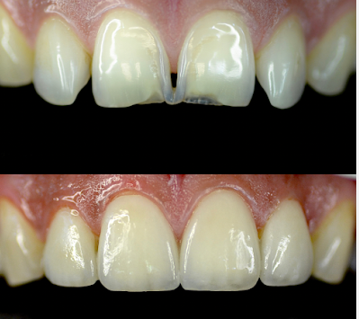 Teeth Cleaning Near Juhu for a Healthier and Brighter Smile with Dent Heal