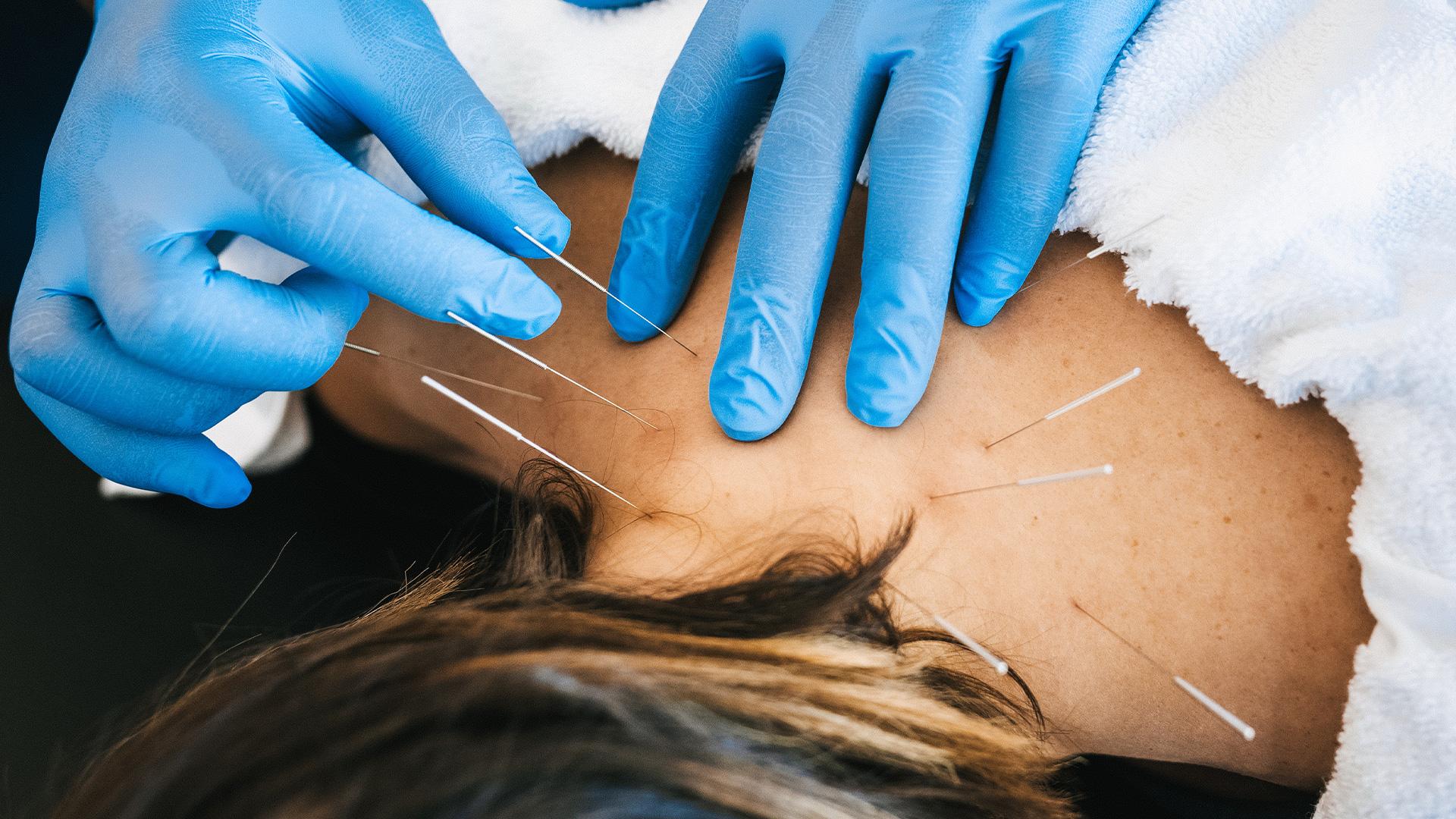 Dry Needling Explained Benefits and Techniques Pro