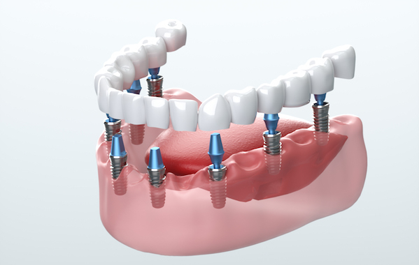 Are Dental Implants Right for You?