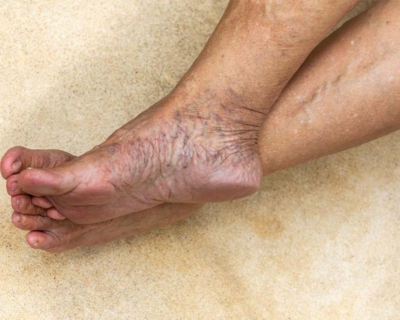 Varicose Veins Treatment: Causes, Symptoms