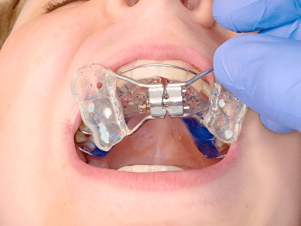 Eating Comfortably While Wearing a Palate Expander: Practical Tips That Actually Help