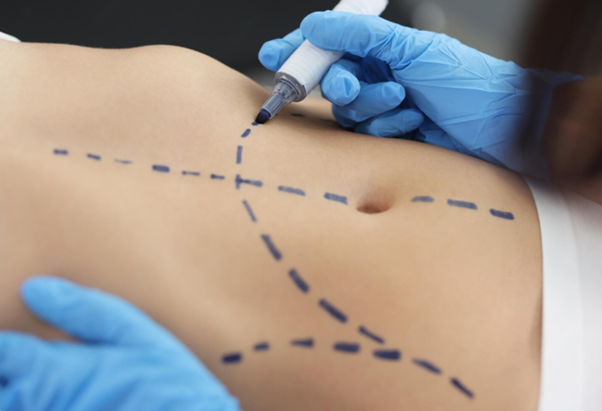 360 Body Contouring in Branson: The Gentle Way to Target Stubborn Fat