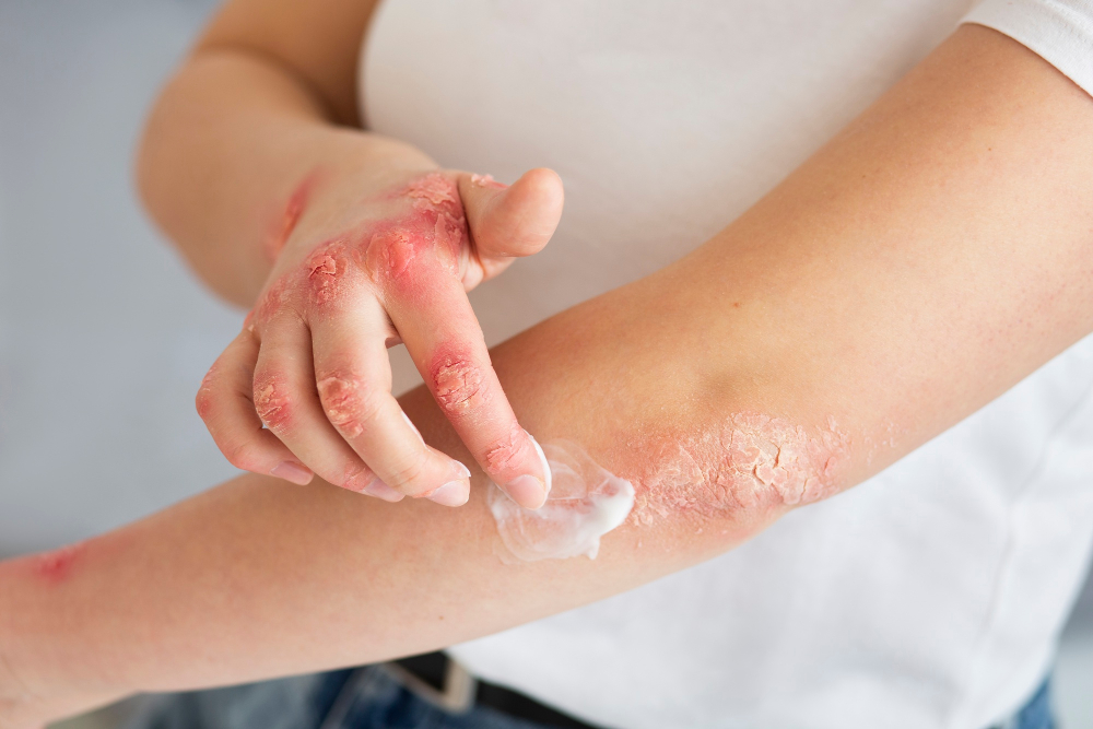 Psoriasis vs. Eczema: Key Differences and Treatment Options