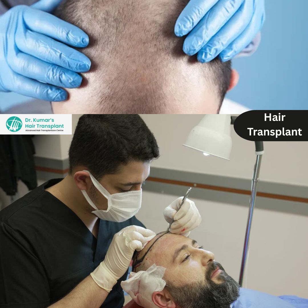 Determine The Cost of Hair Loss Treatment