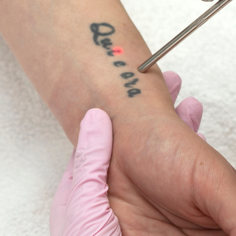 Best Tattoo Removal Machine for Sale: Safe and Effective Results