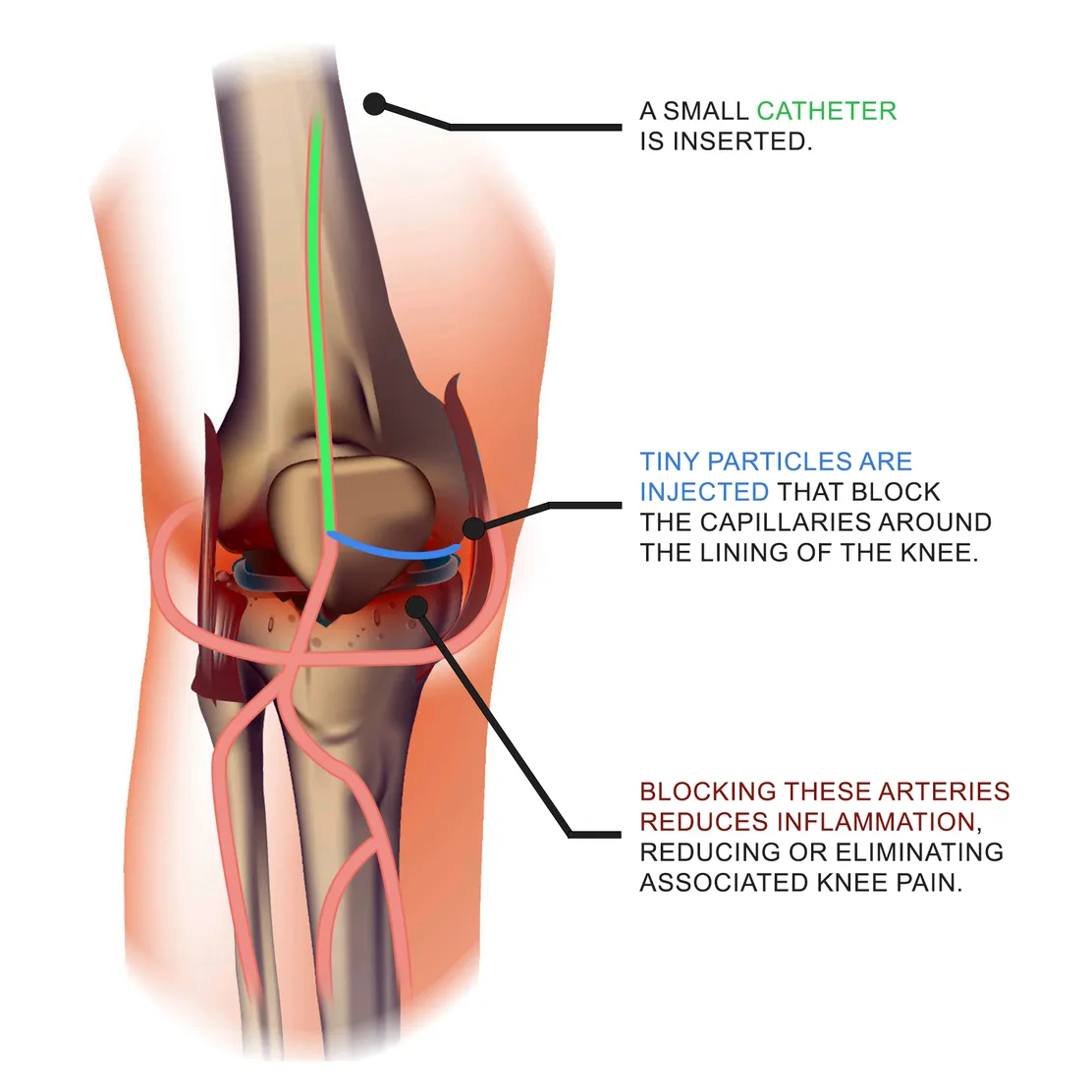 Tired of Knee Pain? Genicular Artery Embolization Might Be the Answer Nobody Told You About
