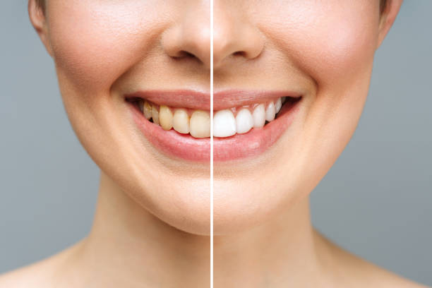 Professional Teeth Whitening vs. Home Kits: What Toronto Residents Should Know