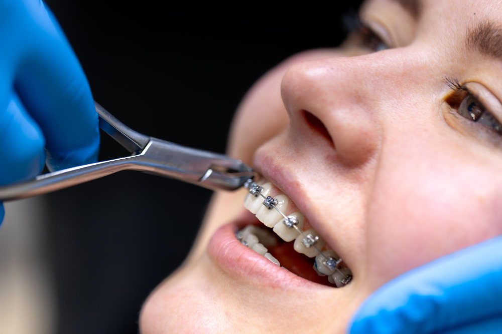 Top Benefits of Getting Braces Treatment in Chembur