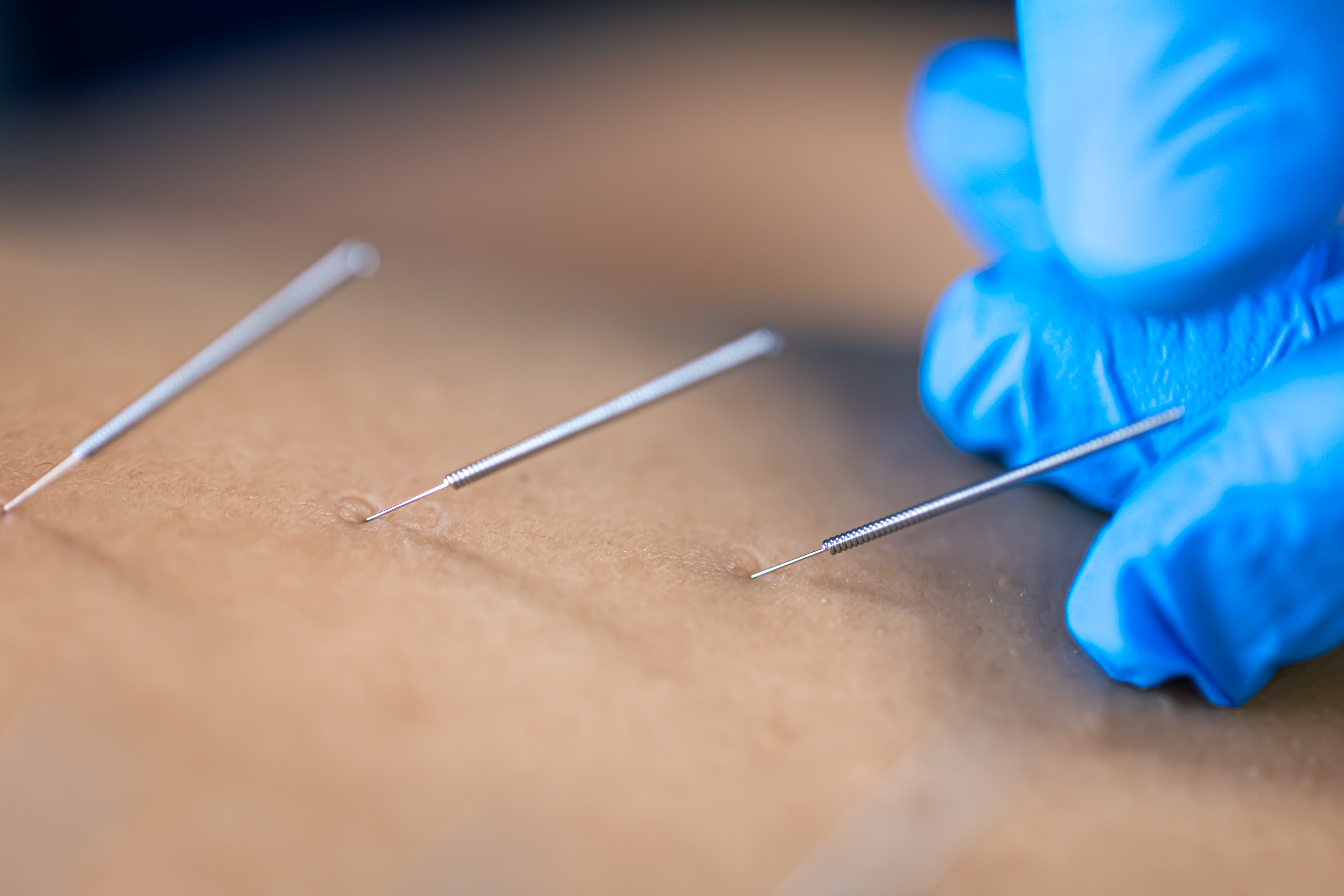 Why Choose Canada for Acupuncture Training? Benefits & Career Scope