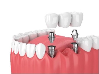 Exploring Different Dental Implant Options Available in London, Ontario