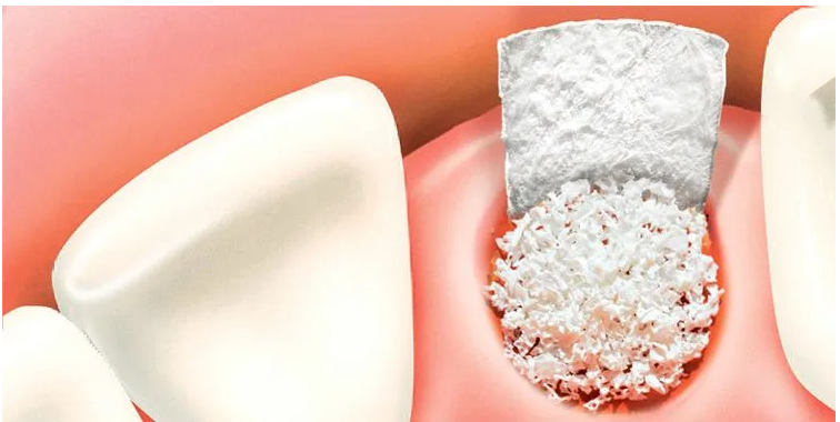 Comprehensive Guide to Bone Graft Dental Implant Philippines for Restoring Your Smile