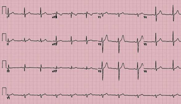 The Difference Between Being Trained to Read EKGs and Actually Being Able to Read Them