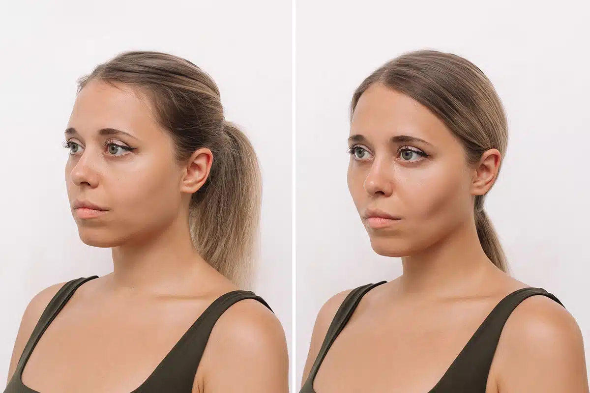Best Buccal Fat Removal in Islamabad for a Slimmer Face