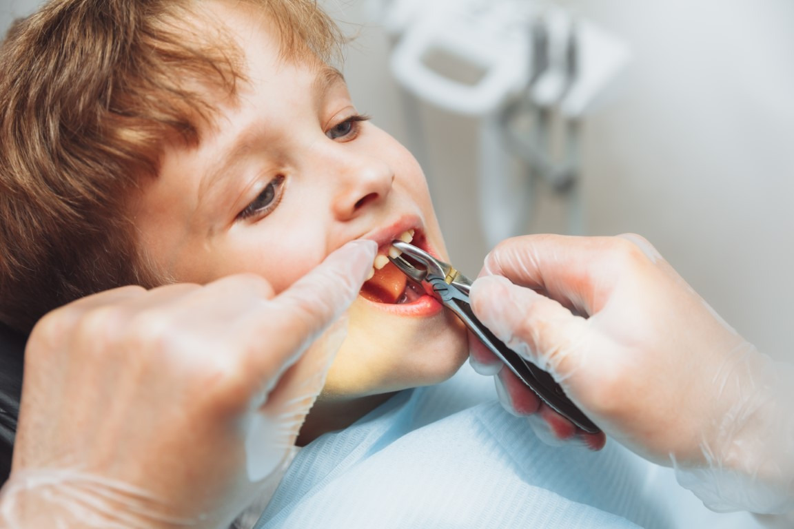 7 Important Things to Know Before Tooth Extraction