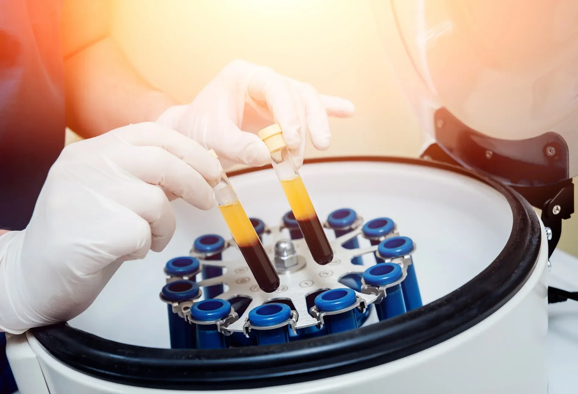 Top PRP Therapy for Treatment of Sun Spots in Highland Park, NJ