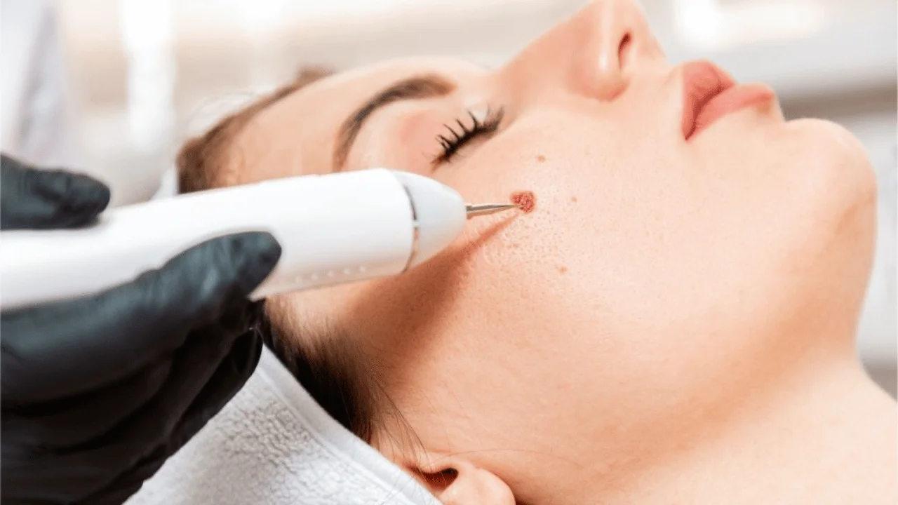 Mole Removal Philadelphia: Cost, Procedure, Recovery, and Results