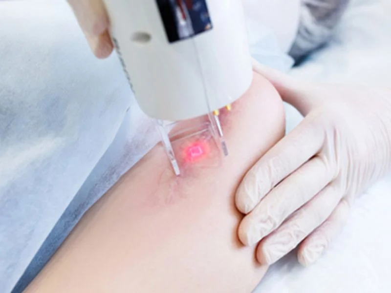 Scar Removal in Dubai – Advanced Solutions for Clear Skin
