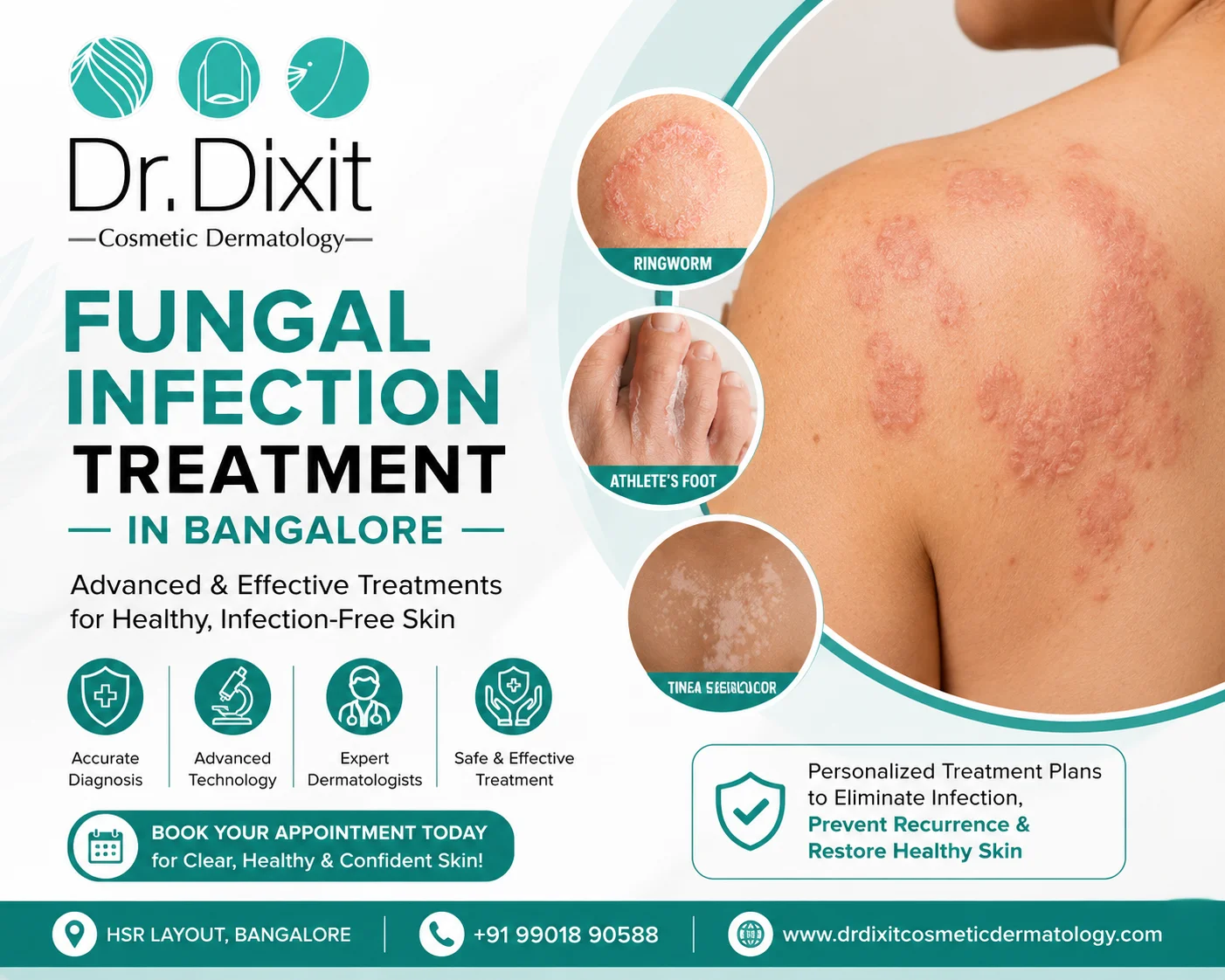 White Patches on Skin: Fungal Infection or Something Else?