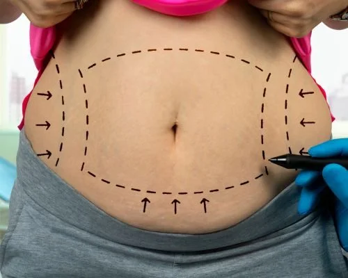 What is the cheapest liposuction cost?
