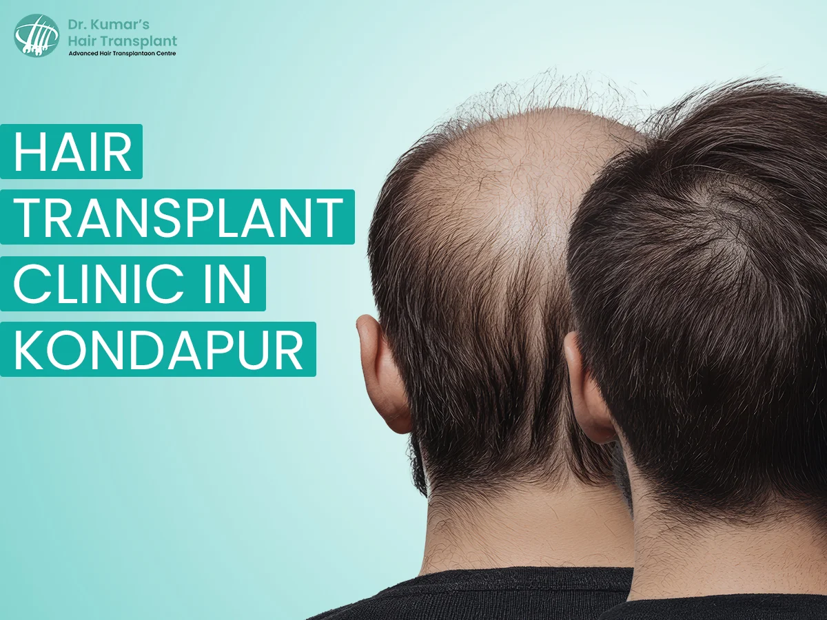 A Simple Guide to Hair Transplant Options in Kondapur, Hyderabad