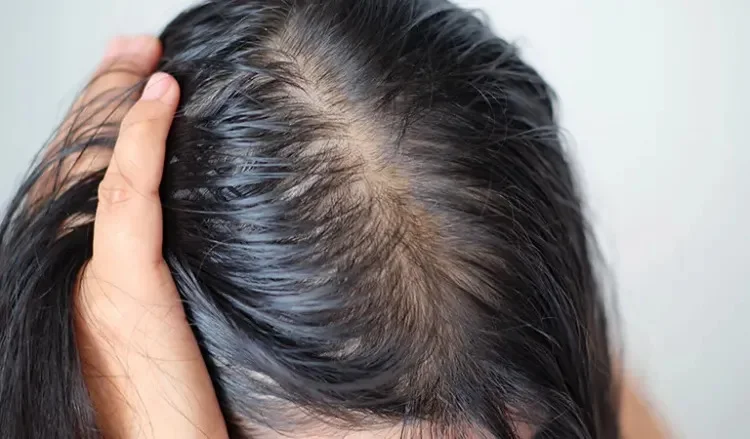 How to Regrow Thinning Hair?