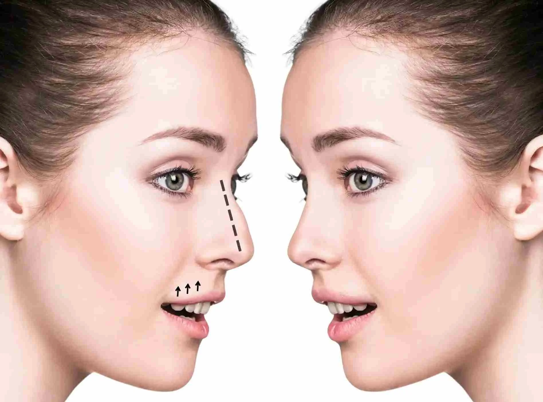 How Can Best Doctors in Dubai Transform Your Rhinoplasty?