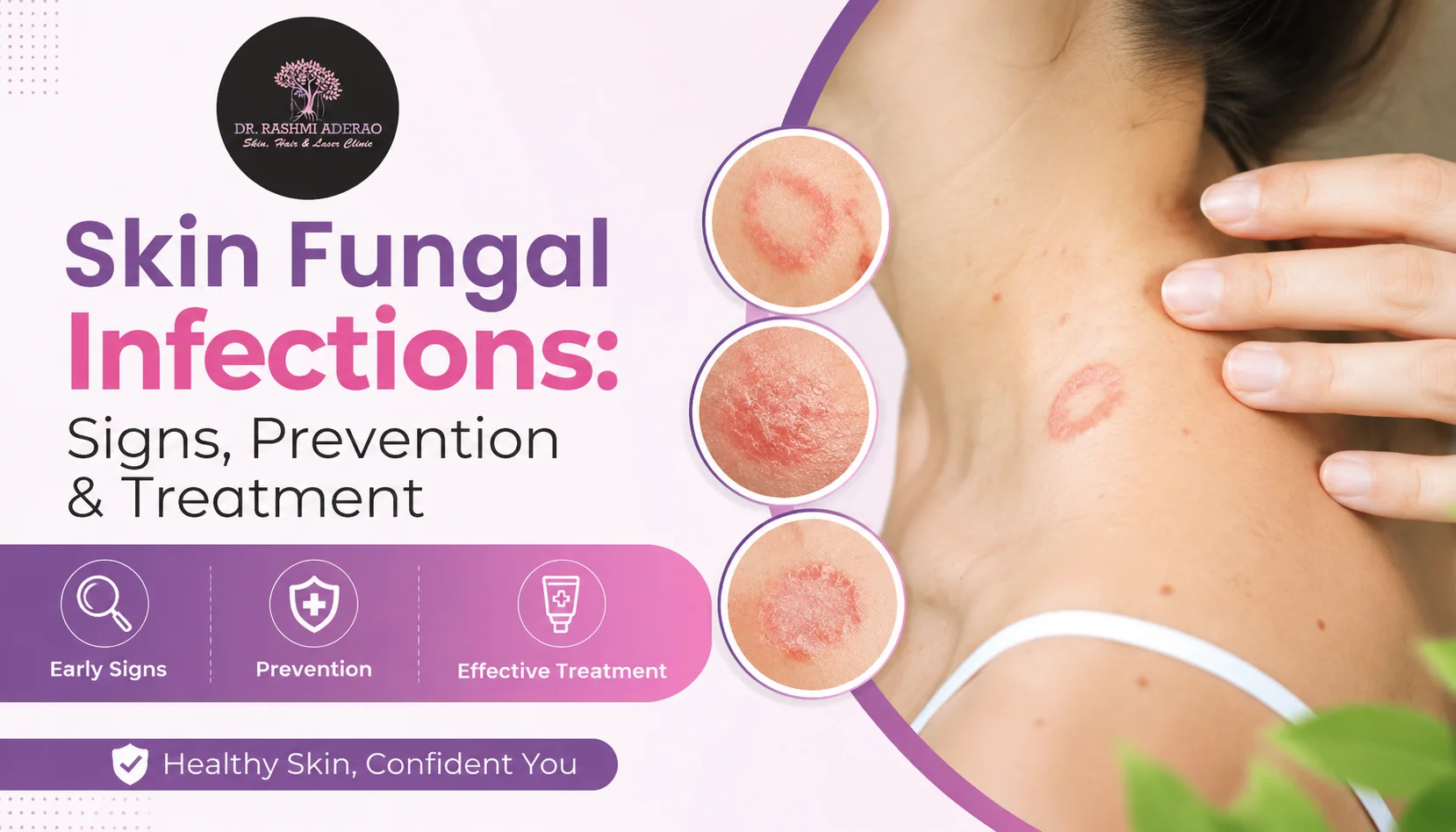 Skin Fungal Infections: Early Signs, Prevention, and Effective Treatment