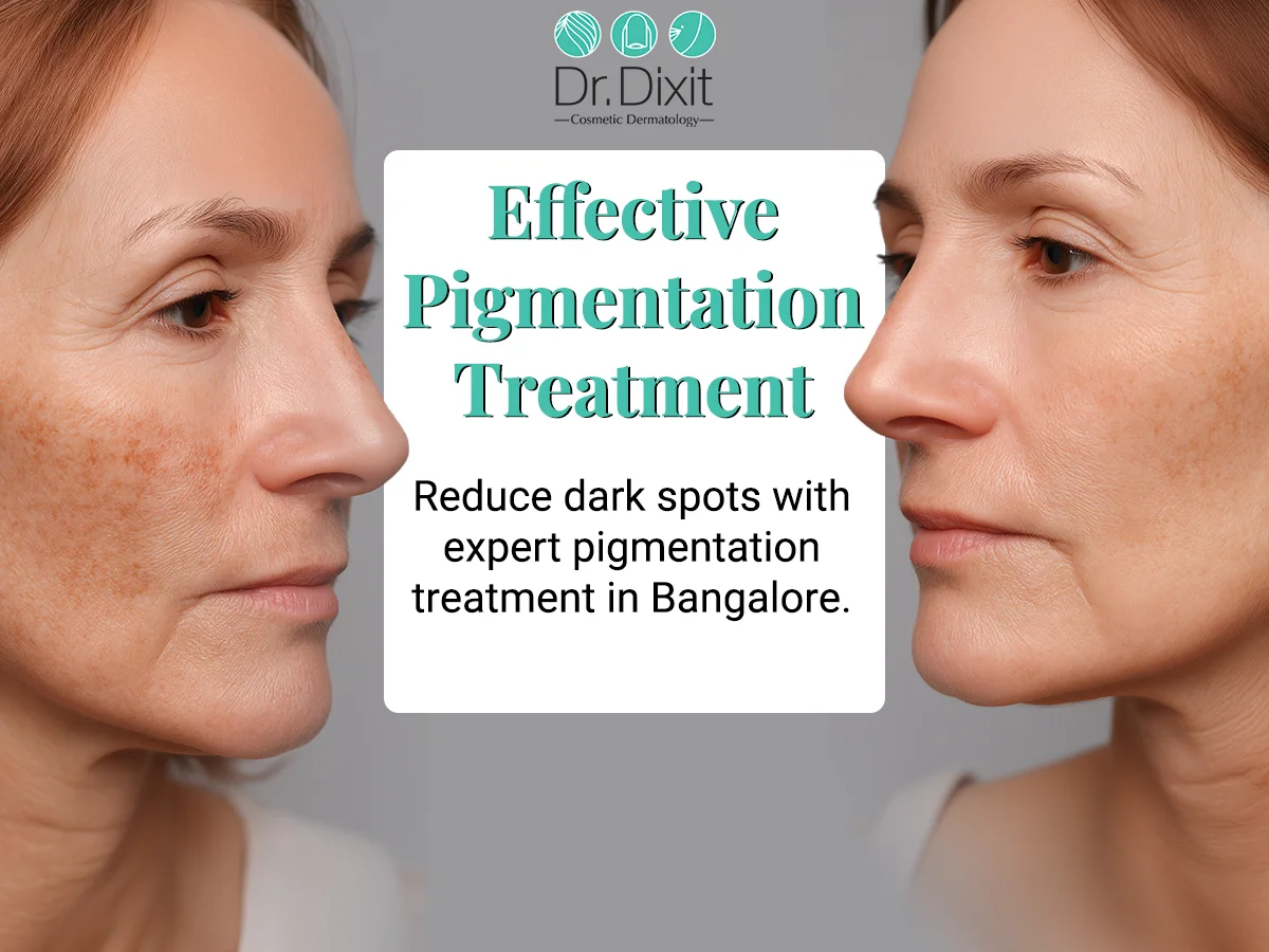 Why Does Post-Pregnancy Melasma Need Dermatologist Help?