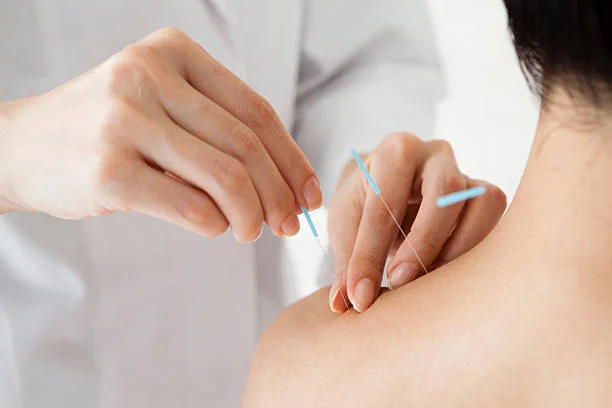 Can Acupuncture Treatment in Dubai Improve Daily Comfort?