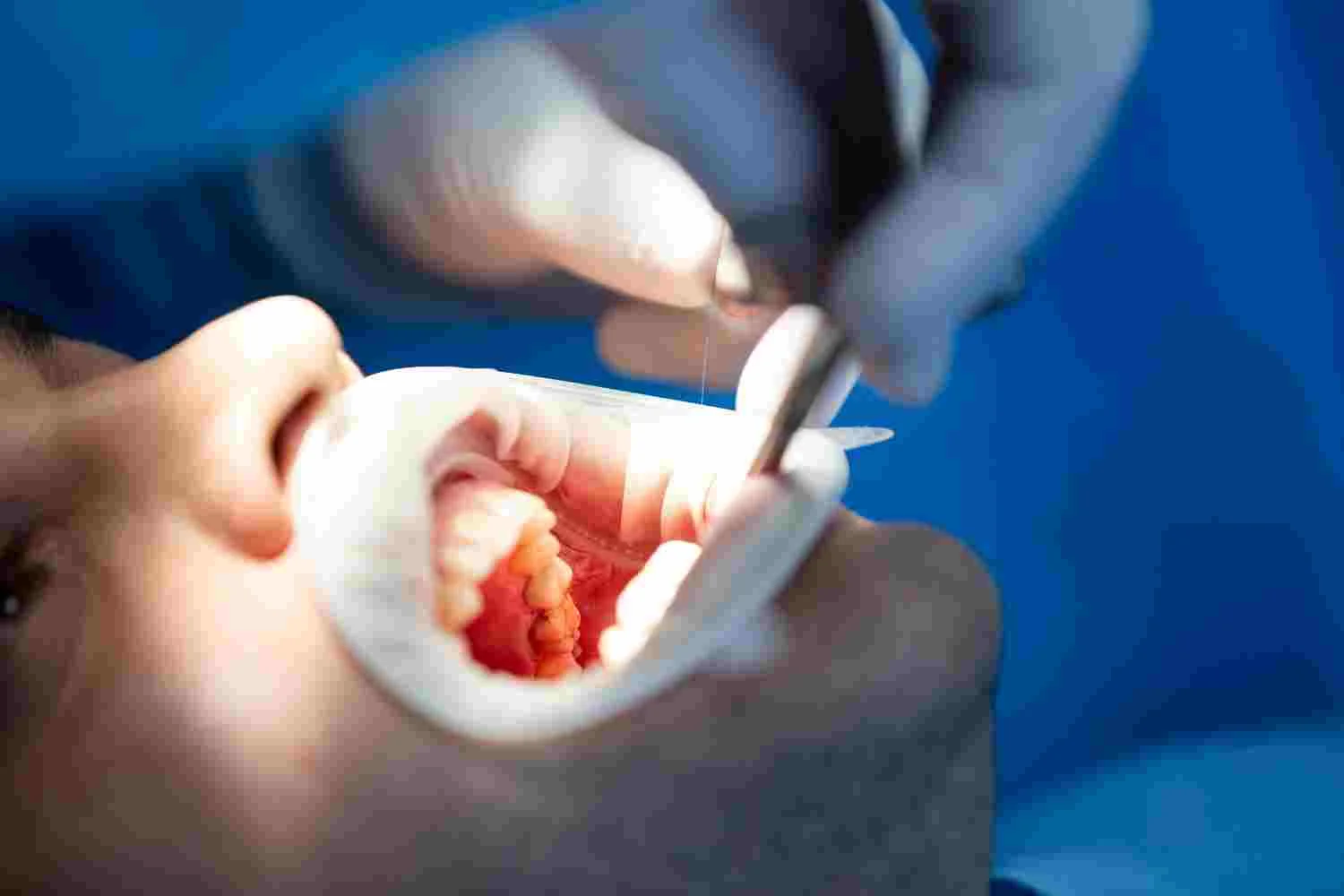 Wisdom Teeth Removal in Diggers Rest