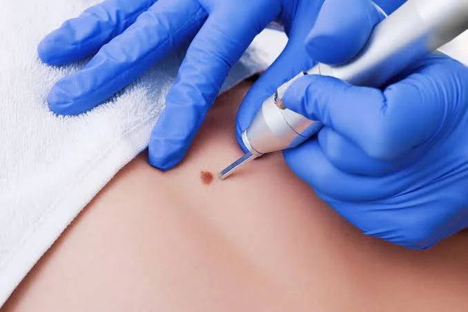 Feel More Like Yourself Again With Professional Skin Tag Removal Kent At Home