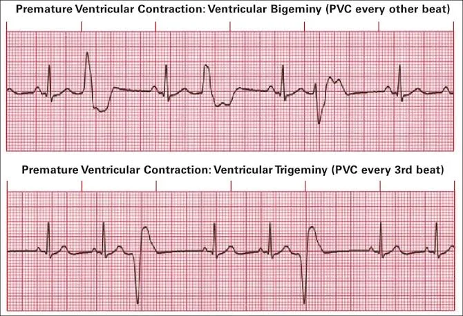 What Are the Treatment Options for Premature Ventricular Contractions in the UAE?