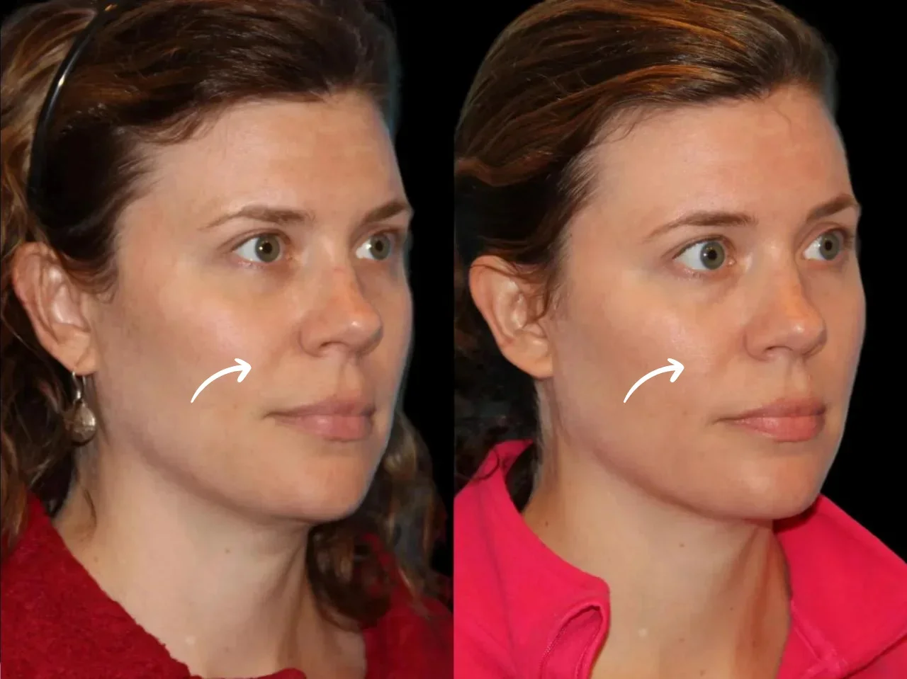 Sculptra Fillers Treatment in Dubai and the Role of Poly-L-Lactic Acid