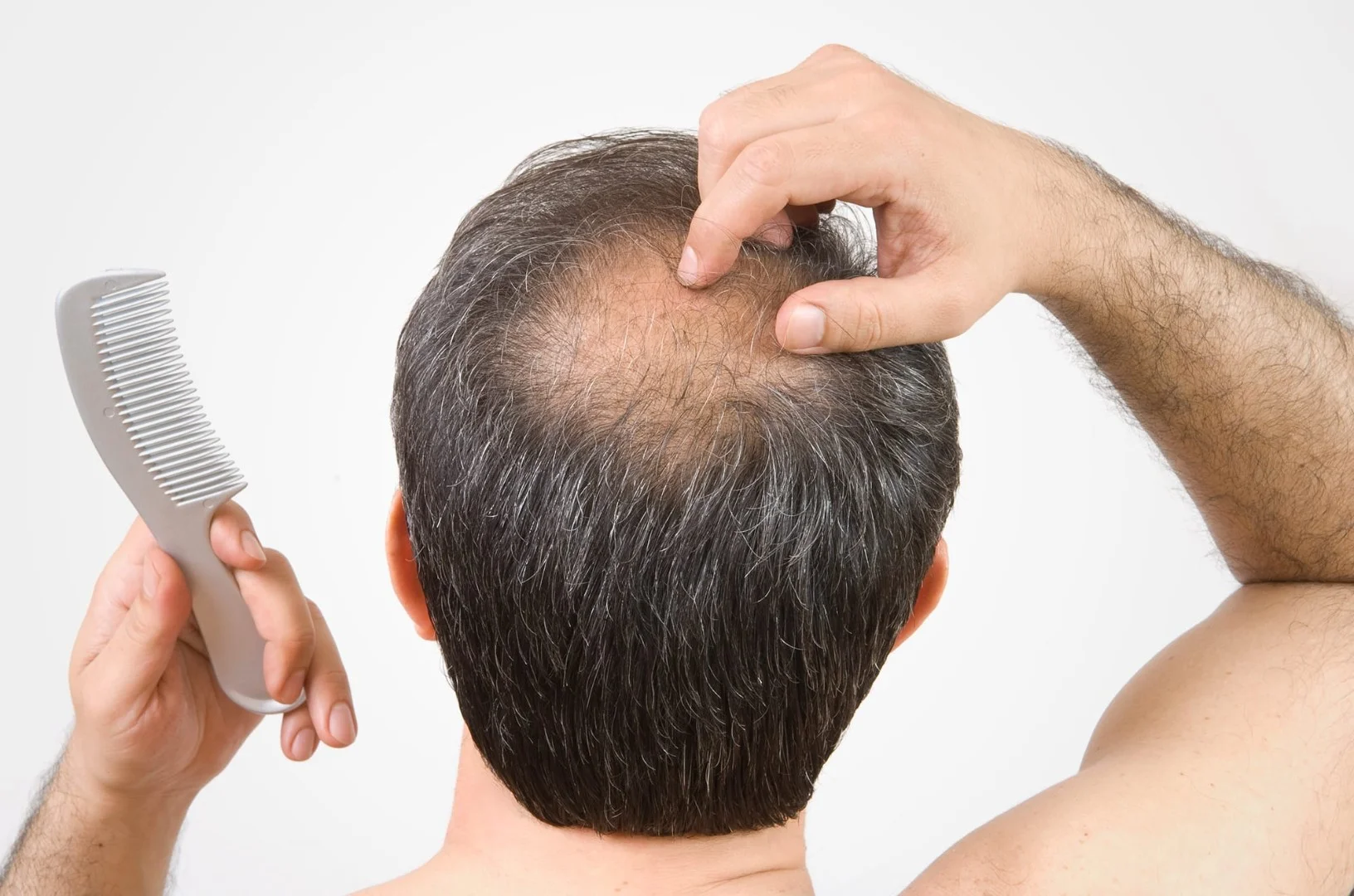 Hair Fall in Women and Men: Simple Guide to Treatment Options in Delhi