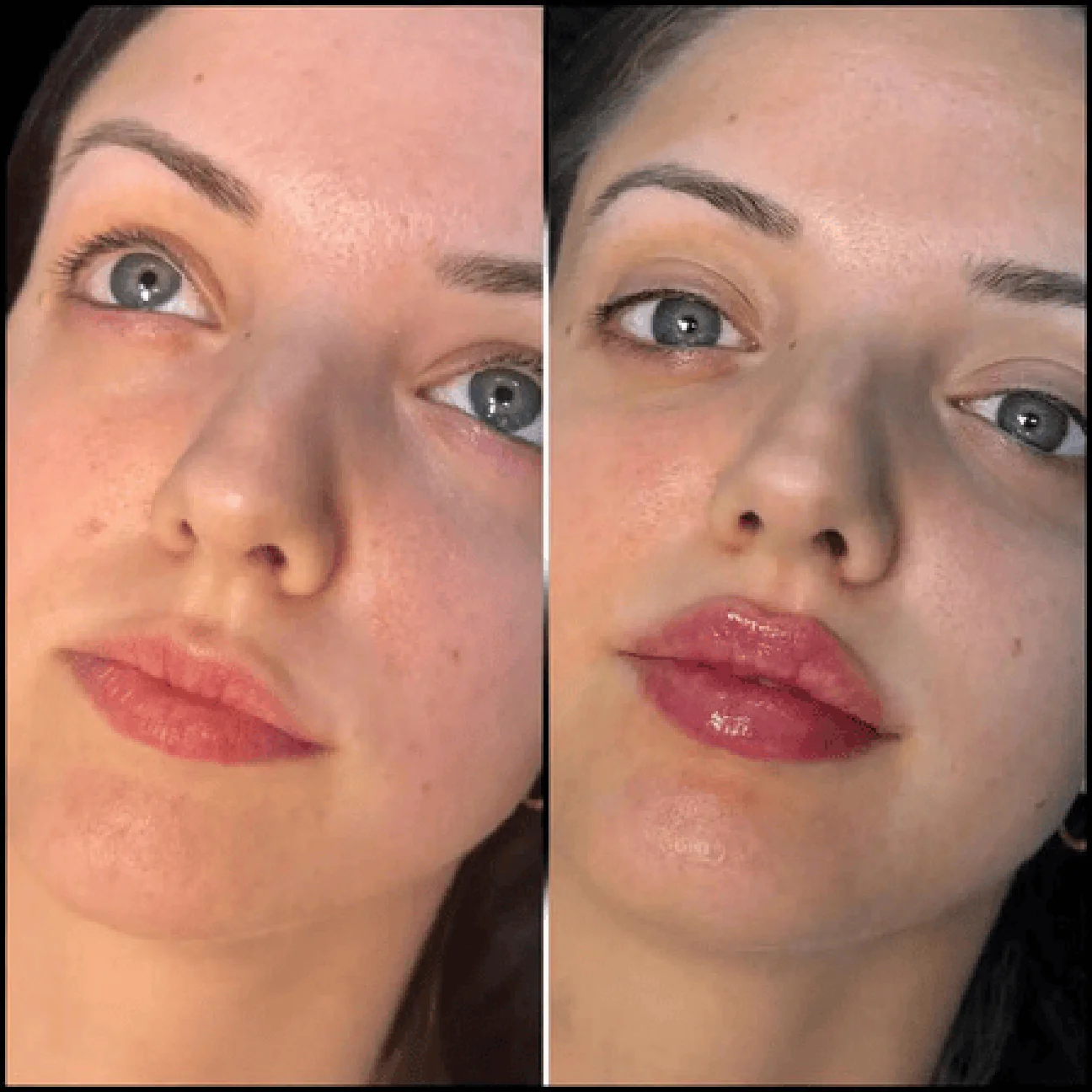 Fillers in Dubai: How to Choose the Right Treatment Areas