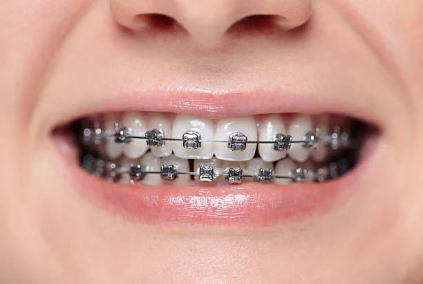 Early considerations for children’s orthodontic treatment and smile development
