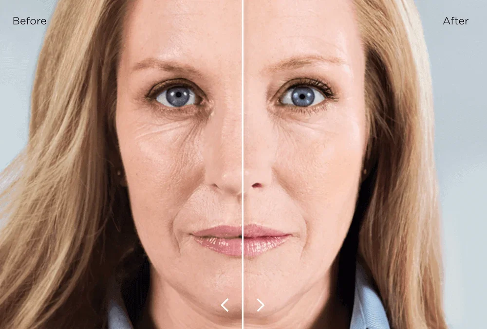 Sculptra Pros and Cons