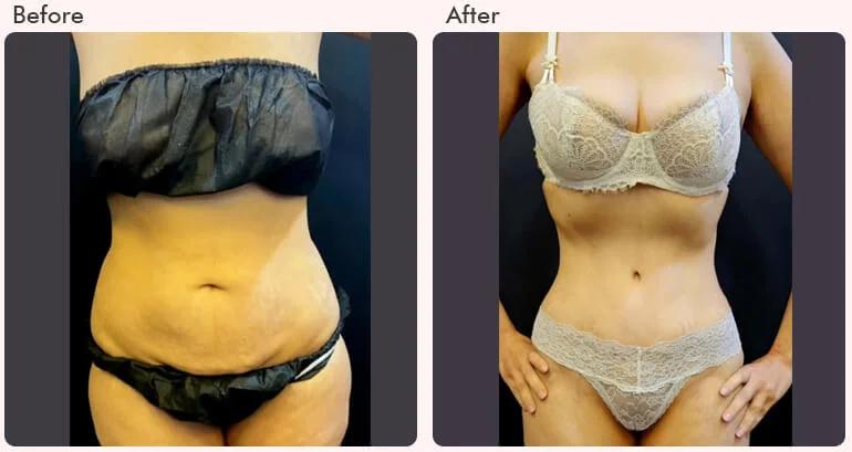 Abdominoplasty surgery in Delhi - Dr Rajat Gupta