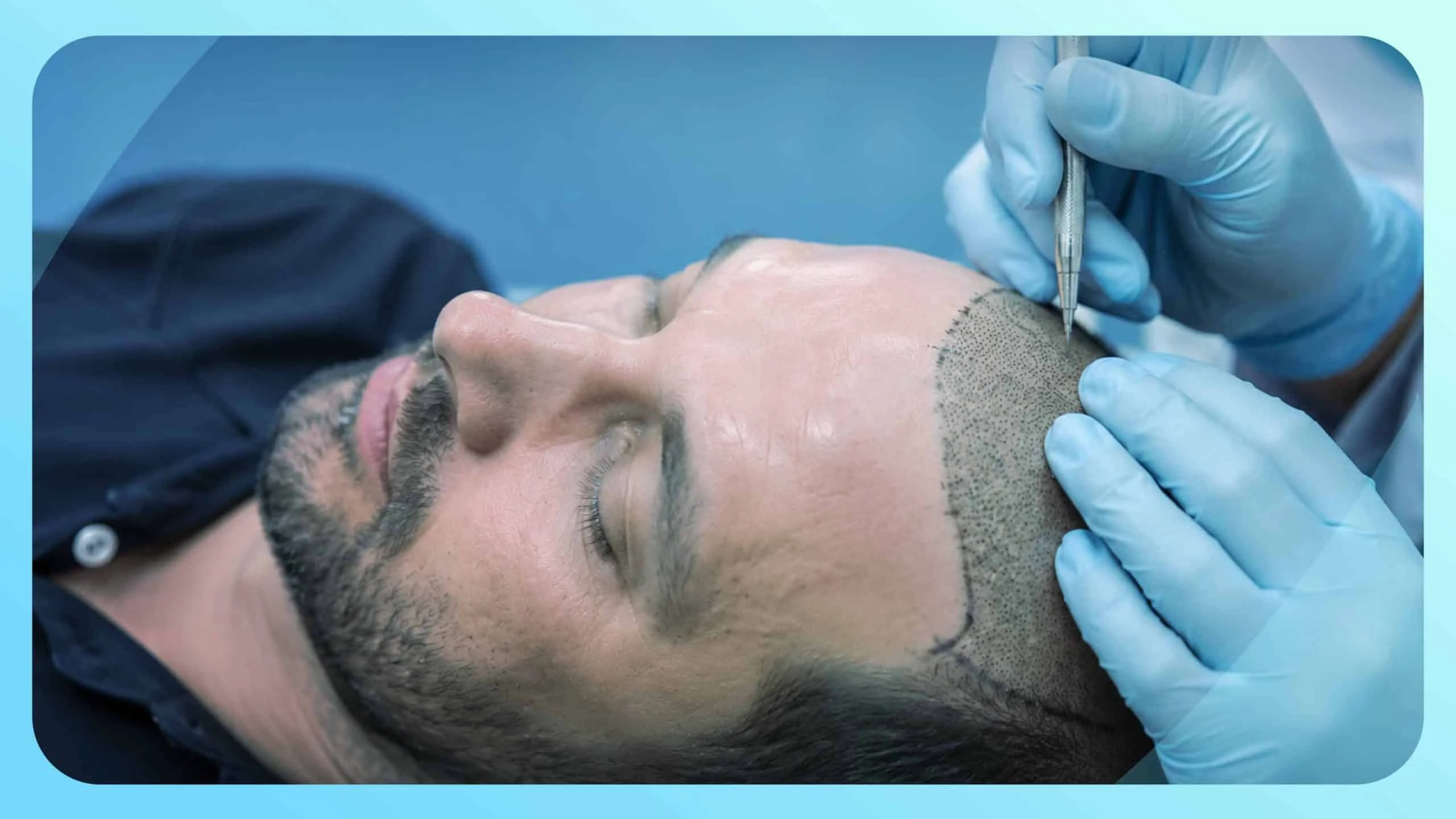 How to Choose the Right Hair Transplant Option in Delhi: A Simple Guide for Patients