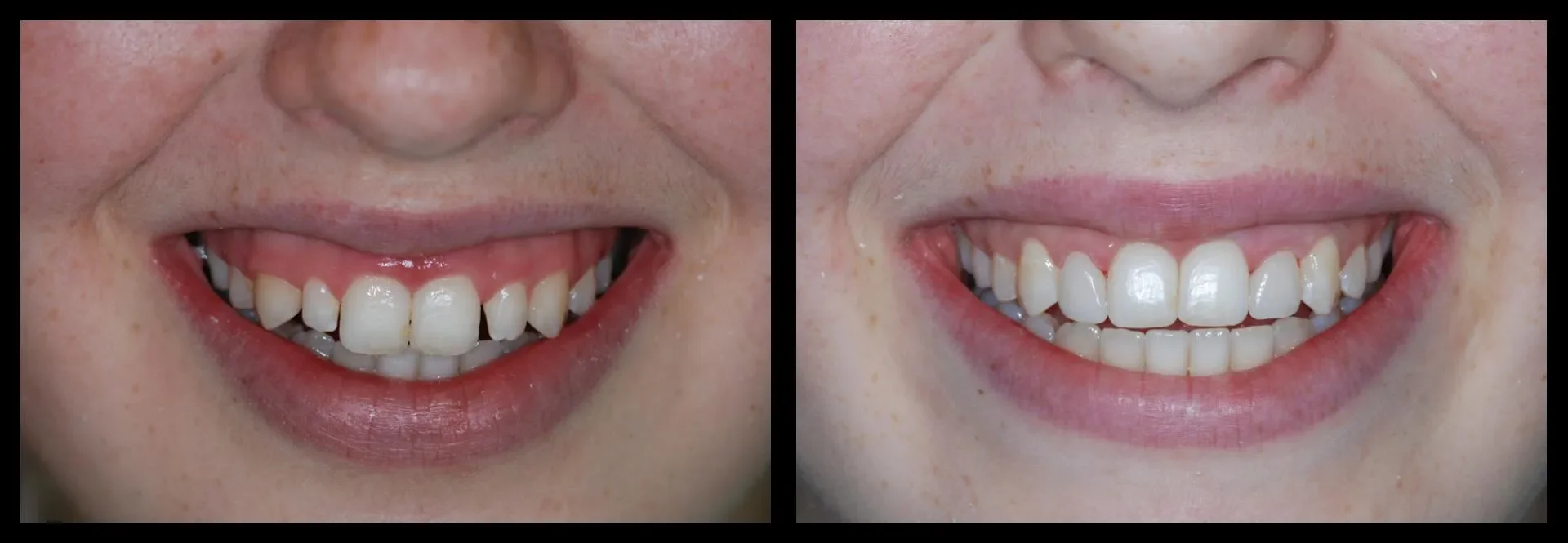 Which Dental Filling Is Best for You?