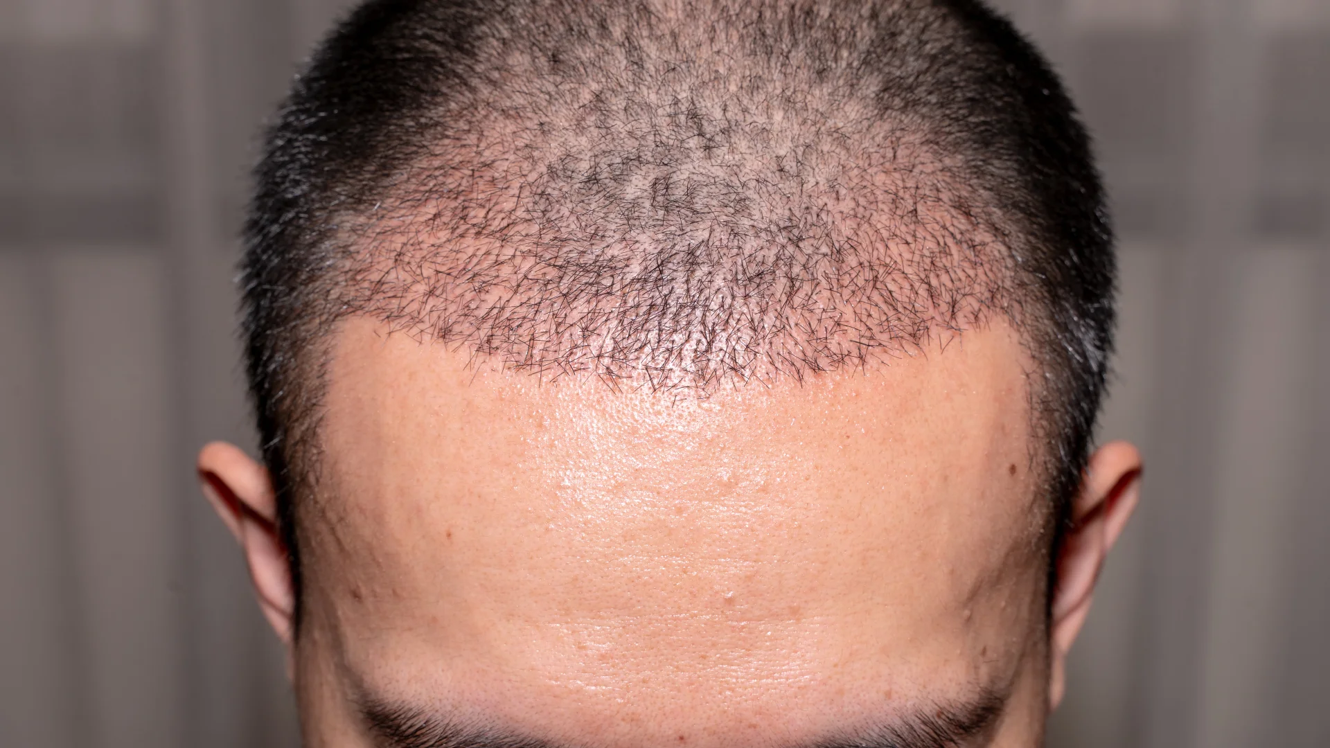 7 Things to Know Before You Book a Hair Transplant in Gurgaon