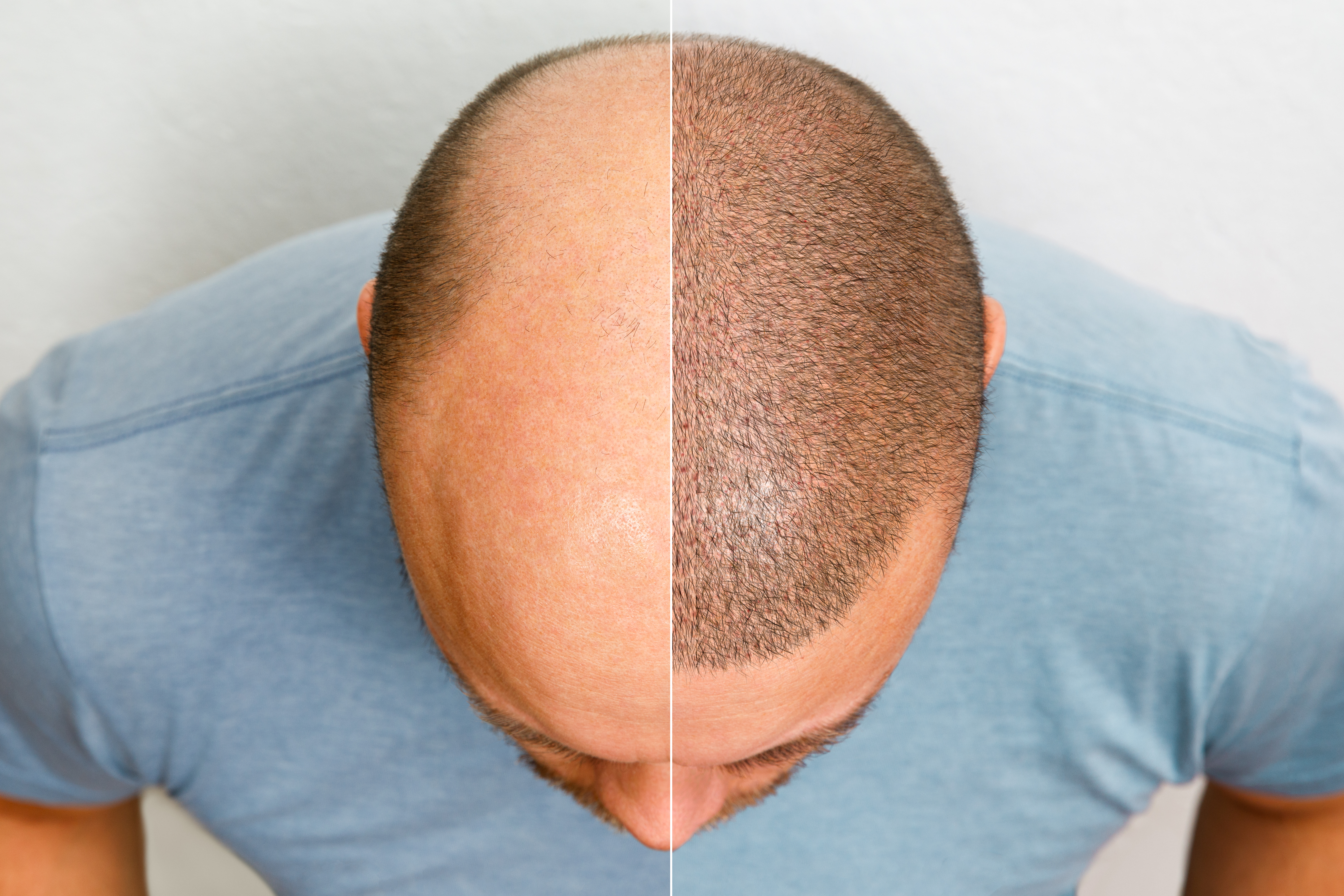 Men Hair Bladness