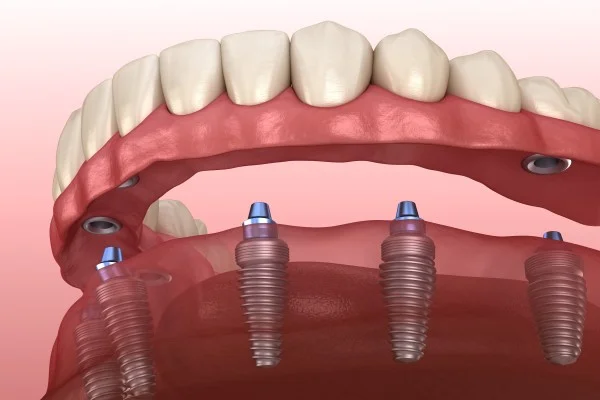 Denture World
